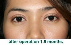 plastic-surgery-blepharoplasty